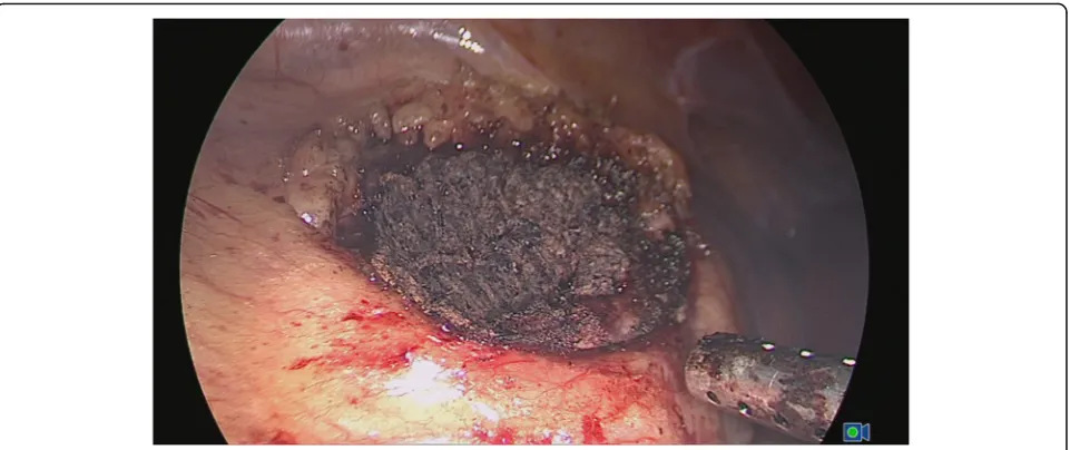 Fig. 2 To achieve satisfactory hemostasis, NBCA was sprayed on the surface of the tumor bed