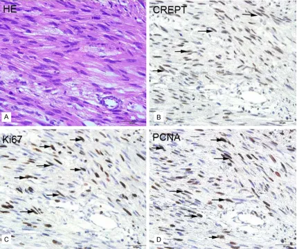 Figure 1. Representative results of the H&E and immunohistochemical staining for CREPT, Ki-67 and PCNA in ret-roperitoneal LMS tissues
