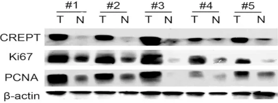 Figure 3. Western blot analysis of CREPT, Ki-67 and PCNA expression in ret-roperitoneal LMS tumor and normal adjacent tissues