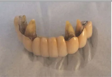Fig 1 Panoramic X-ray: important bone resorption with mediocre prosthetic design. n with mediocre prosthetic 