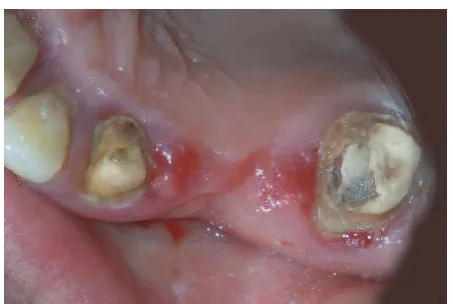 Fig 10 Bridge's fracture at the connection ...  