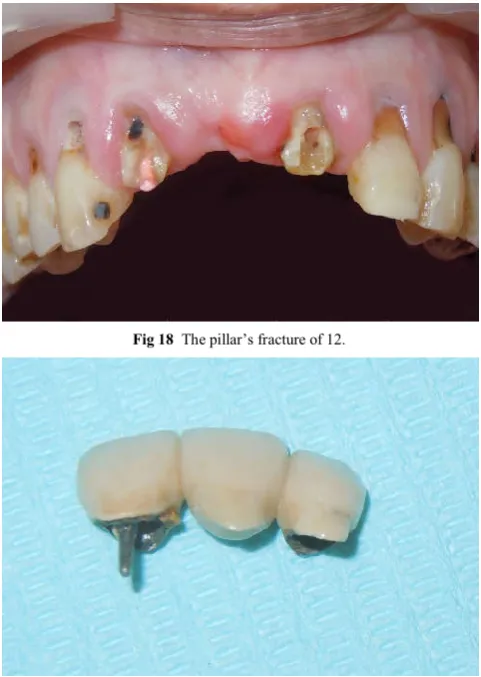 Fig 18  The pillar’s fracture of 12. 