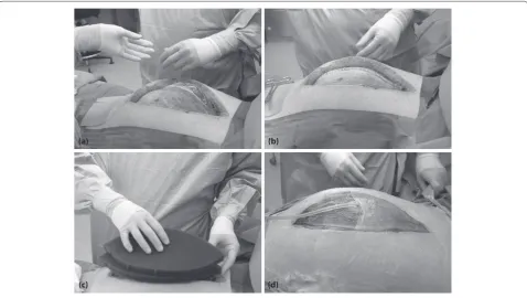Figure 1. (a-d) Mesh-assisted vacuum-assisted closure dressing.