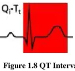 Figure 1.8 QT Interval 