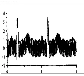 Figure 2.2 ECG Corrupted due to Power Line Interference 