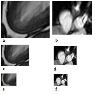 Figure 4: a, b are the Apex and Arteries Templates, c -f are the 2nd and 3rd Resolution of Images