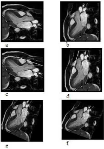 Figure 10: a, and b Systole Rotated and Normal Image Resp. c and d the Apex, Arteries Segments Located, e and f both Images after Alignment in the Same Direction
