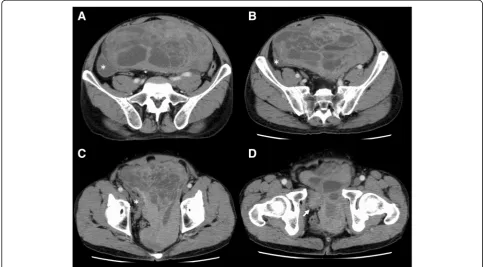 Fig. 1 Enhanced abdominal CT. a, b, c A large multilocular mass with soft tissue component displacing the bladder (*) and rectumanterolaterally