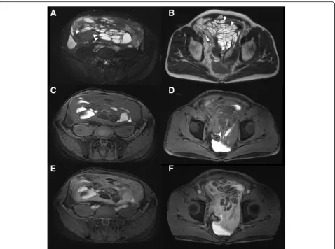 Fig. 2 a, b T2-weighted MRI. Most cysts showed high intensity suggesting simple fluid, and some showed the presence of layering whichsuggests the likelihood of either fat or blood in content