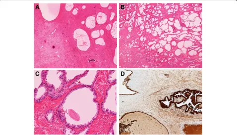 Fig. 5 Pathological examination of the resected specimen. a Low-power magnification of cystadenoma of the prostate with densefibromuscular stroma (H&E, original magnification × 20)