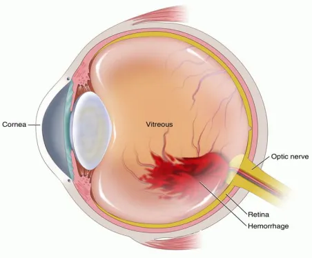 Figure 1.1:- Vitreous Haemorrhage 