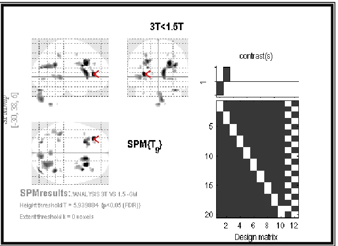 Figure 1. Statistical parametric maps, in sagittal, coronal and axial projections, showing clusters of increased gray matter in 3.0 Tesla  MPRAGE scans relative to 1.5 Tesla MPRAGE scans