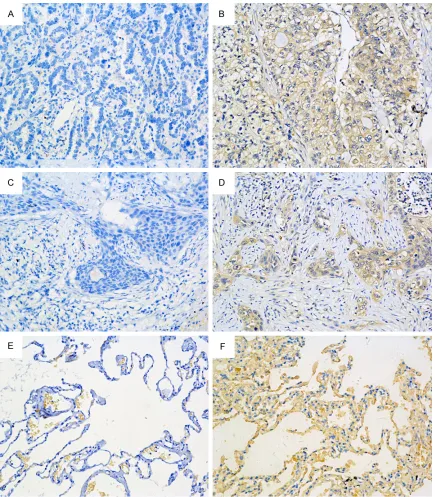 Figure 1. Representative immunohistochemical staining of B7-H6 in non-small lung cancer tissues and adjacent non tumor tissue