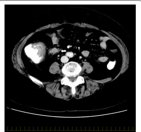 Fig. 1 Extranodal neoplastic spread (ENS): the white arrow indicatesa lymph node with ENS