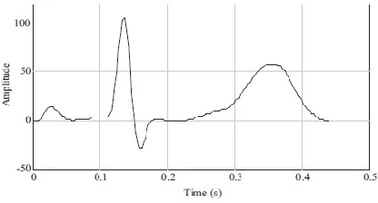 Fig.1 Electrocardiogram (ECG) signal 