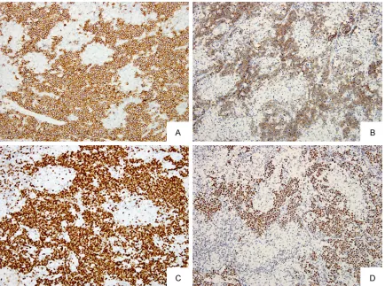 Figure 2. Immunohistochemistry (A-C). Atypical lymphocytes are positive for CD20 (A), CD10 (B), and nearly 100% of atypical lymphocytes are positive for Ki-67 (C) (× 200)