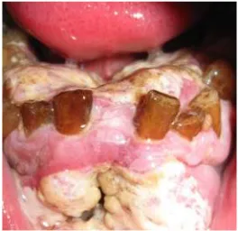 Figure 7: Oral cancer 
