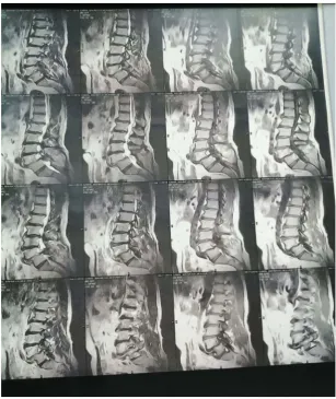 Figure 2. The post-operative X-ray lumbosacral (LS) spine, anterior posterior (AP), and lateral view at 3 months with posterior instrumentation