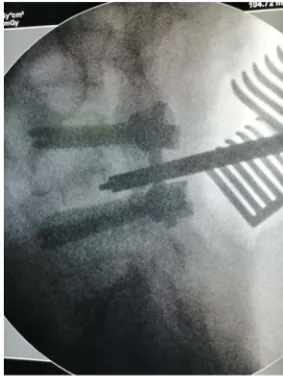 Figure 4. The post-operative X-ray lumbosacral (LS) spine, AP view at 9 months. 