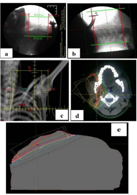 Figure 1. Simulation images showed (a) Larynx simulation two opposing fields sparing the tracheostomy, (b) hypopharynx simulation two opposing fields including the posterior cervical lymph nodes, (c) anterior supraclavi-cular simulation field targeting sup