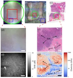 Fig. 5. Co-registration of handheld scans and post-operative histology of a specimen containing IDC