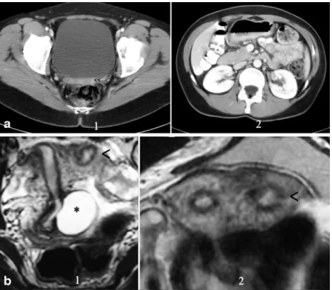 Fig. 5 Rokitansky syndrome and unicornuate uterus. a (1) CT in a patient with Rokitansky syndrome showing the  utero-vaginal rudimentary area under the bladder (&lt;&lt;)