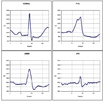 Fig 2 Four common types of heartbeats. [21] 