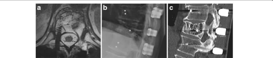 Fig. 1 CT scan (a, b) of the lytic lesion of the T12 vertebra with unilateral posterolateral involvement