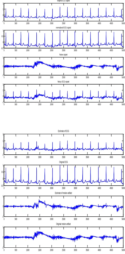 Figure 05: ECG File load ('4.txt'), Noise Added = “MA” using Adaptive Filter  