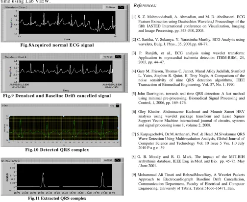 Fig.8Acquired normal ECG signal 