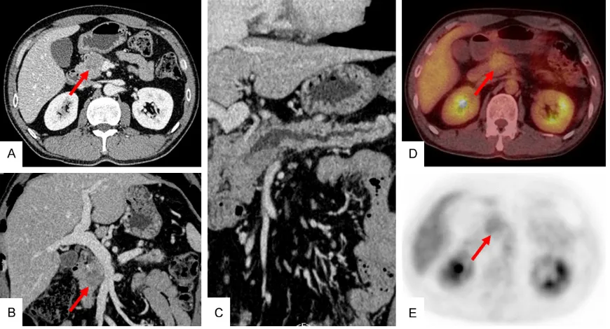 Figure 1. A. Portal venous phase of contrast enhanced CT shows a light enhanced mass in the head of the pancreas
