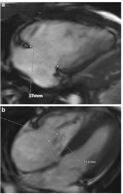 Fig. 11 Tricuspid regurgitation (TR). (Tethering. Four-chamber SSFP MRI image shows distance from theannular plane to coaptation in systole > 8 mm and area > 1.6 cmprecession (SSFP) image in a patient with functional TR shows dilation ofthe annulus > 35 mm