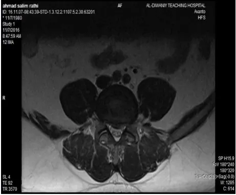 Figure 1: Sagittal MRI T2 weighted image showing normal disk signal intensity, no signs of prolapsed disk 