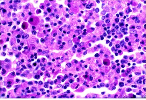 Figure 2Crystalline inclusion bodies in tissue section with PAS stainCrystalline inclusion bodies in tissue section with PAS stain Periodic-Acid-Schiff Staining (medium power × 250) reveals sheets of neoplastic plasma cells with multiple intracytoplasmic crystalline inclusion bodies both within the plasma cells and the adjacent histiocytes.