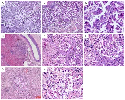 Figure 2. The tumor A of case 29 (A-C) was composed of micro-papillary and lepidic component