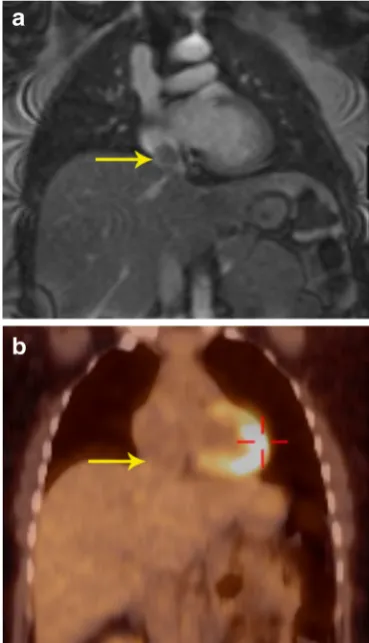 Fig. 4 Characterization of mass. a Coronal first-pass perfusion MRimage in a patient who presented with chest pain and IVC mass onechocardiography shows a mass that demonstrates contrastenhancement similar to the liver parenchyma