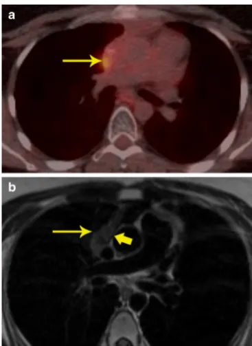 Fig. 6 Localization of abnormal activity.there is a heterogeneously enhancing mass in the right ventricle (arrow)that is extending to the right ventricular apex and also invading the right a FDG-PET/CT image in apatient with breast cancer shows intense upt