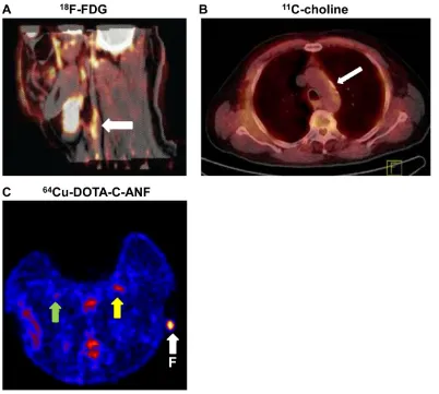 Fig 3. PET imaging of the atherosclerotic lesion. atherosclerosis with various tracers