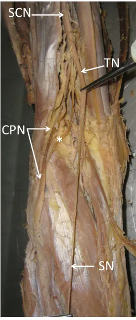 Figure 1. Showing variation in the formation of the sural nerve in left lower limb. SCN: Sciatic nerve; CPN: common peroneal nerve;  TN: tibial nerve; SN: sural nerve arose directly from the tibial nerve; asterisk: communicating branch between tibial nerve and common peroneal nerve  