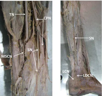 Figure 2. Showing variation in the formation of the sural nerve in right lower limb. CPN: common peroneal nerve; TN: tibial nerve; SN: sural nerve arose directly from the common peroneal nerve; MSCN: medial sural cutaneous nerve; LDCN: lateral dorsal cutaneous nerve; LCN: lateral calcaneal nerve 