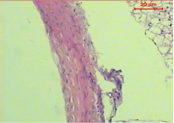 Figure (2): Micrograph of transverse section of aorta of diabetic rat shows a significant atherosclerosis, vacuolation in the cells of the tunica media (H & E, Scale Bar: 20 µm)  