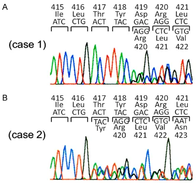 Figure 1. Detection of exon 8 c-kit gene mutations. A. Heterozygous mutation of Del-Asp419 is shown in case 1