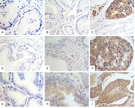 Figure 1. Immunohistochemical analysis of MST4, STK25 and PDCD10 antigen expression in benign prostatic hy-perplasia tissues and prostate cancer tissues