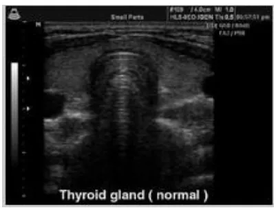 Fig I: Normal Thyroid US image 