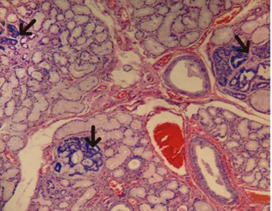 Figure 1. Multifocal canalicular adenoma of the up-per lip. Multiple tumour nodules (arrows) located in glandular tissue