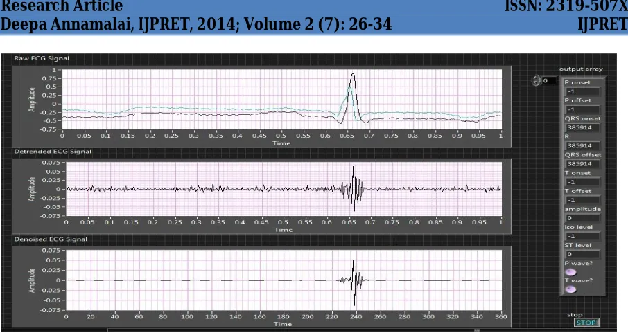 Figure 9. Original ECG, ECG after Detrending, Denoising and QRS parameters detection 