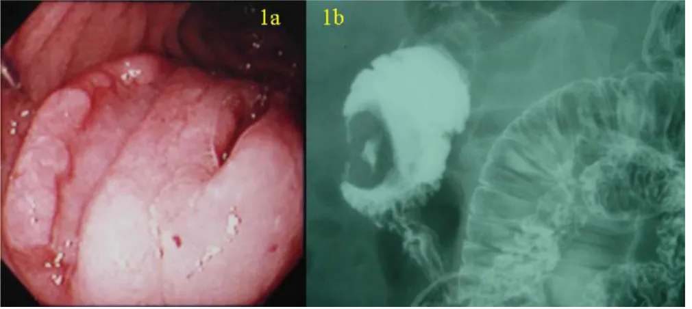 Figure 1second portion of the duodenum(a) Duodenoscopy showing a 3 × 3 cm protruding tumor with two ulcerations located opposite the ampulla of Vater in the (a) Duodenoscopy showing a 3 × 3 cm protruding tumor with two ulcerations located opposite the ampu