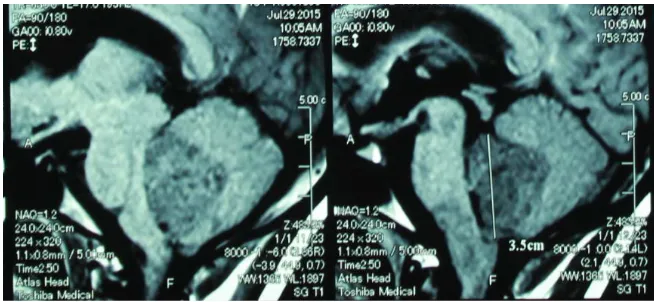 Figure 2. MRI (sagittal view, T1) of case n˚3. Tumor located in fourth ventricle and me-dulla oblongata