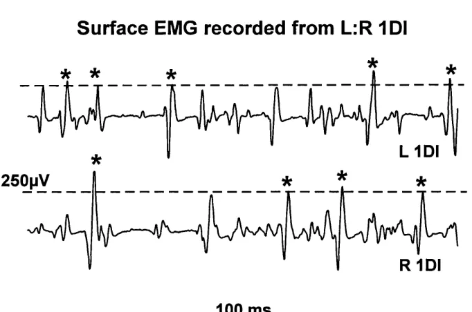 Figure 1: Surface EMG recorded from right and left IDI in a normal adult subject. The line indicates the set level of the level detector, and the asterisks denote the spikes used as triggers and events.