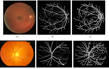 Figure 6.(a)                                               (b)  (a) Digital color retinal image from KMC database; (b) Segmented vessels